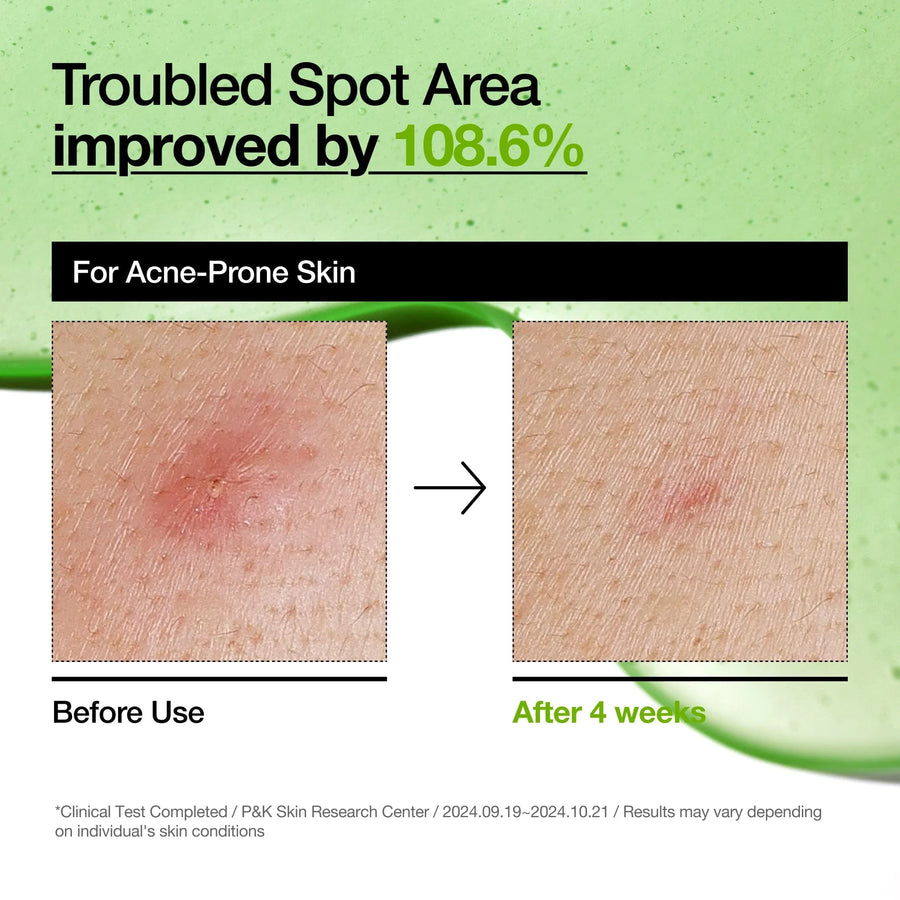 Anua Azelaic Acid 10+ Hyaluron Soothing Serum - 30ml