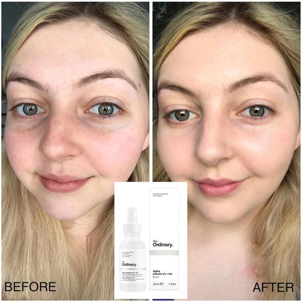 The ordinary نياسيناميد 10% زنك1% - solution